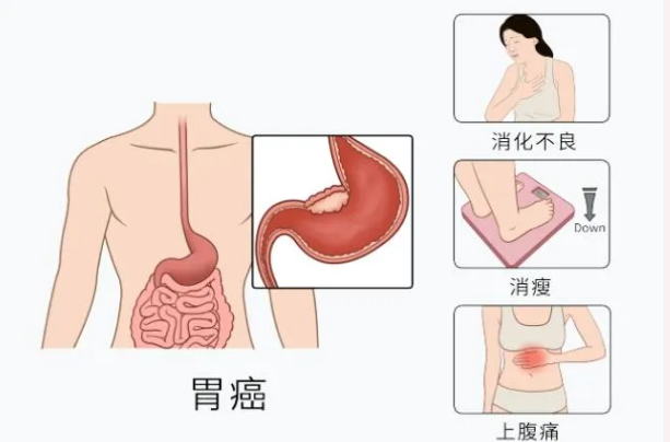 魔高一尺，道高一丈：胃腸鏡—消化道早癌克星